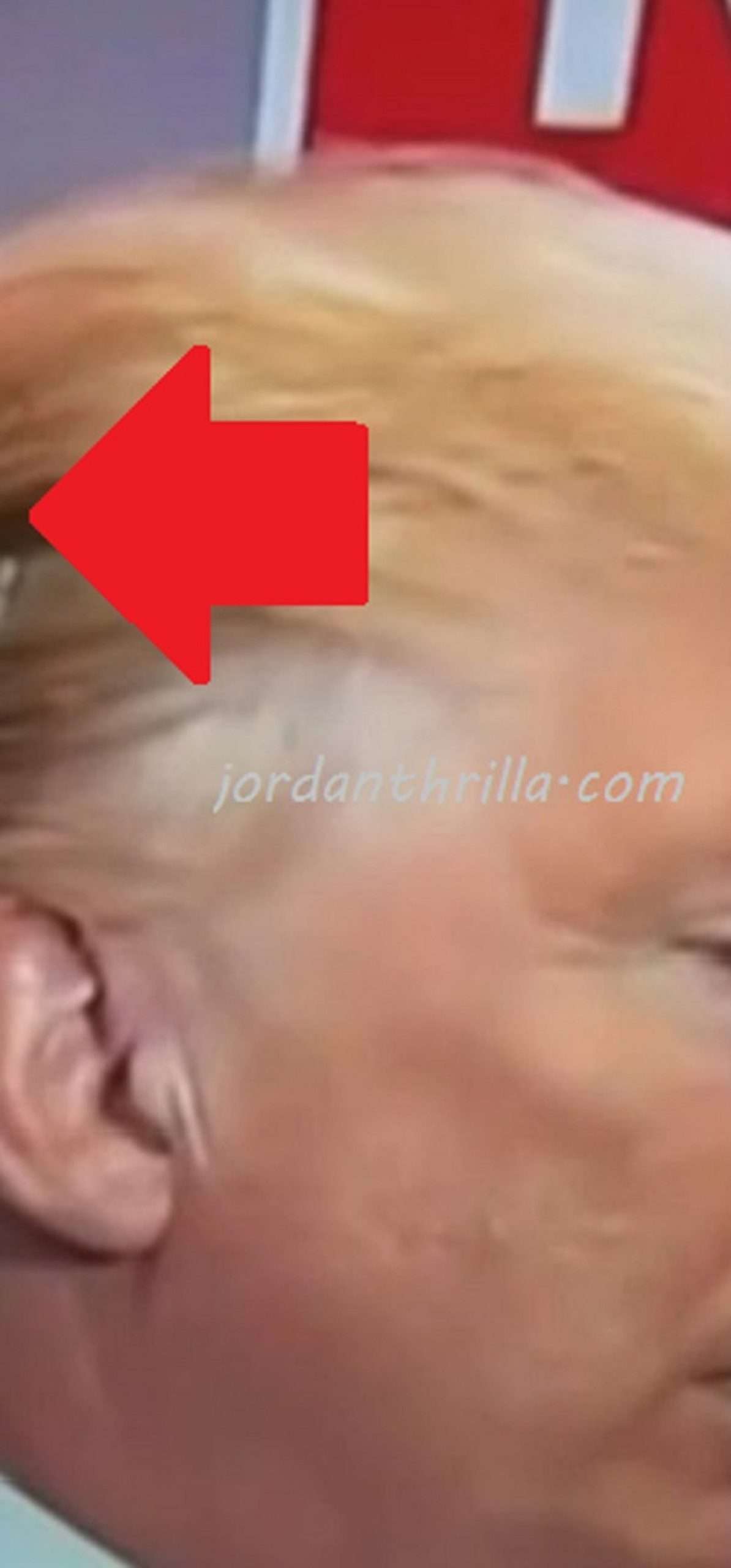 The Donald Trump Clone Conspiracy Theory Emerges After Strange Silver Patch Seen on Trump's Scalp