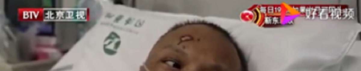Faces of Two Chinese Doctors Turn Black from Coronavirus COVID-19 Infection in Viral Video in China