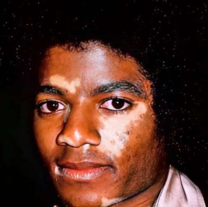 Leaked photo of Michael Jackson with Vitiligo Spots on His Face Skin Before Alleged Skin Bleaching