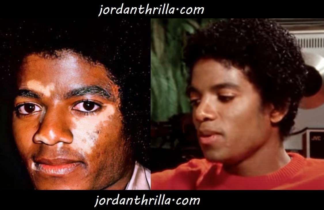 Leaked photo of Michael Jackson with Vitiligo Spots on His Face Skin Before Alleged Skin Bleaching