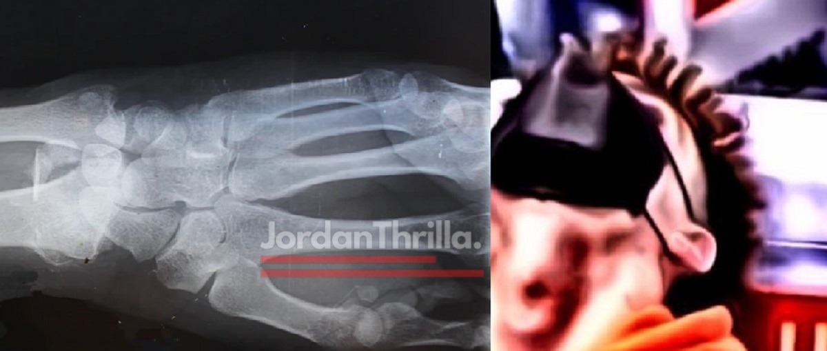 X-Men LaMelo Ball Heals Broken Wrist Like Wolverine And Is Cleared To Return To Court One Month Early.
