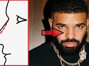 Did Drake Get a Nose Job Plastic Surgery?