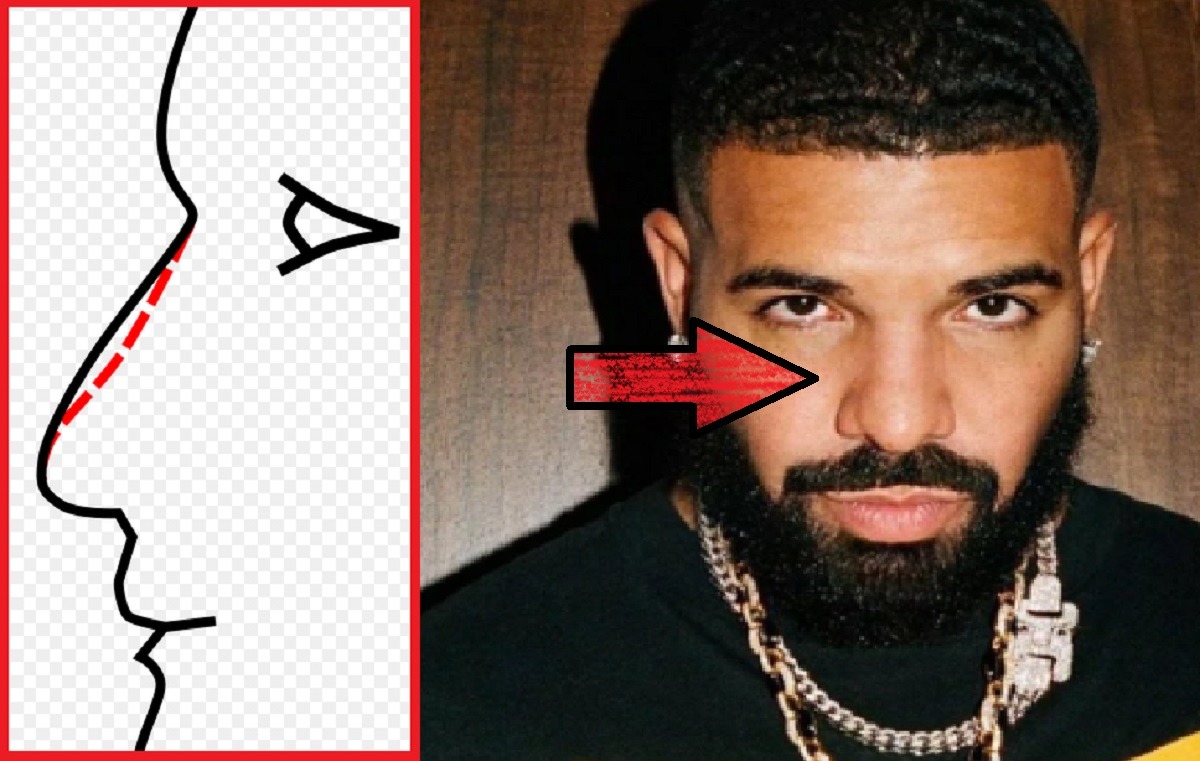 Did Drake Get a Nose Job Plastic Surgery?