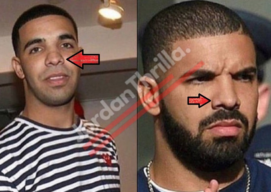 Did Drake Get a Nose Job Plastic Surgery? - JordanThrilla