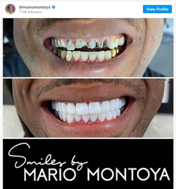 Are These Plies Rotten Teeth In Dentist Photo?