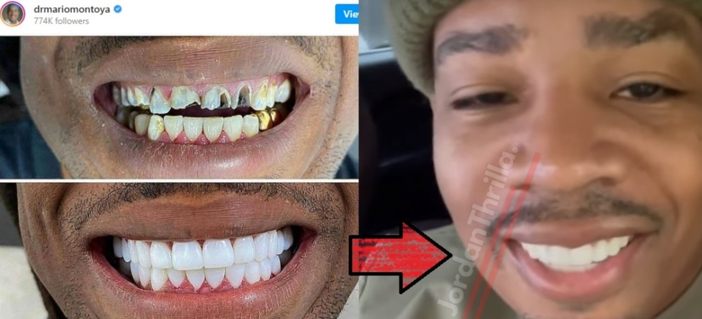 Are These Plies Rotten Teeth In Dentist Photo?