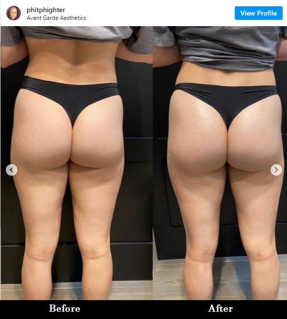 Nonsurgical Butt Lift? Vacuum Therapy Butt Lift Allegedly Makes Your Butt Bigger With No Surgery. Detail about Avant Garde Aesthetics Vacuum Therapy butt lift procedure