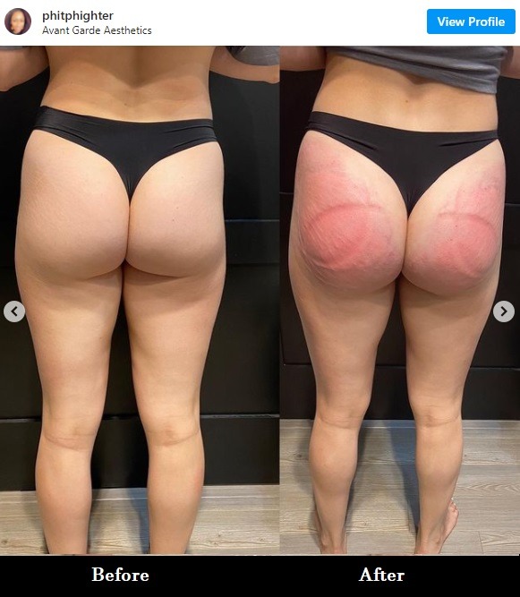 Nonsurgical Butt Lift? Vacuum Therapy Butt Lift Allegedly Makes Your Butt Bigger With No Surgery. Detail about Avant Garde Aesthetics Vacuum Therapy butt lift procedure
