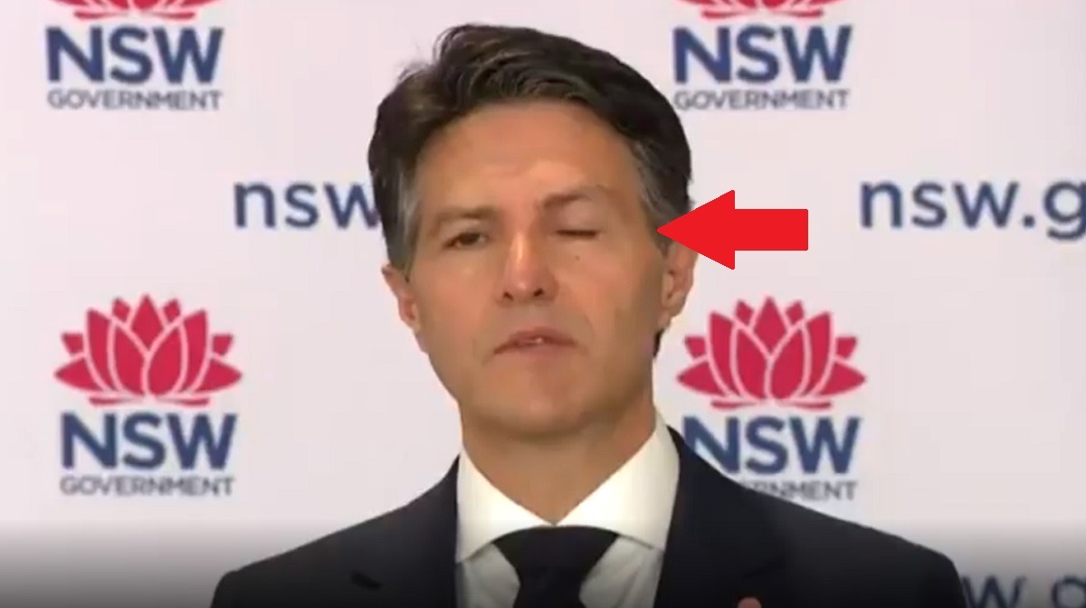 Is Australian Minister Victor Dominello's Droopy Eye Bell's Palsy a COVID Vaccine Side Effect? Details son how COVID-19 Vaccine caused Victor Dominello droopy eye bell's palsy. A Time Line Between Victor Dominello's Bell's Palsy Diagnosis and His COVID-19 Vaccine Jab