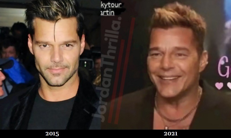Did Ricky Martin Get Cosmetic Surgery in 2021? New Details Behind Rumor of Ricky Martin Plastic Surgery in 2021. Here is Why People Think Ricky Martin Got Plastic Cosmetic Face Surgery. Details on Ricky Martin cosmetic surgery. The reason why Ricky Martin got plastic surgery.