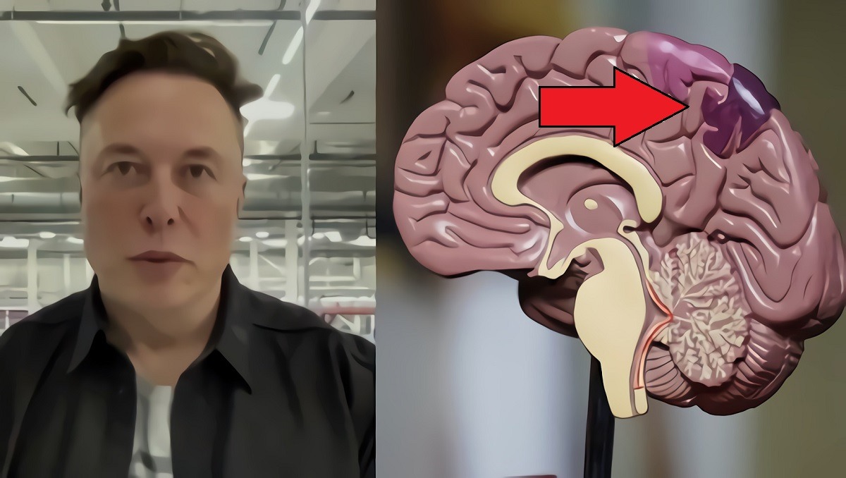 Elon Musk Reveals When Neuralink Brain Chip Implants Will Be Implanted in Human Brains. What Type of Human Brains Will Neuralink Brain Chip Be Implanted in?
