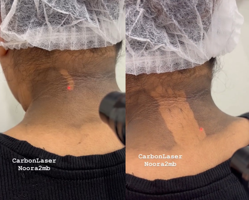 A Black Woman's Neck Before and After a Carbon Laser Peel skin bleaching
