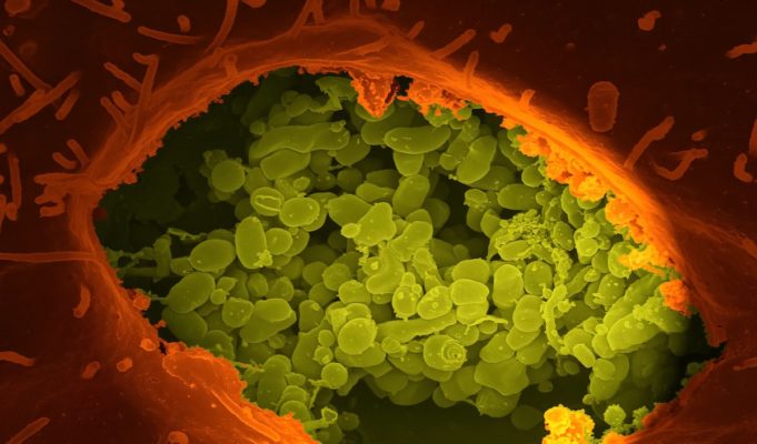 Did Hurricane Ian Start a Flesh Eating Bacteria (Vibrio Vulnificus) Pandemic in Florida?