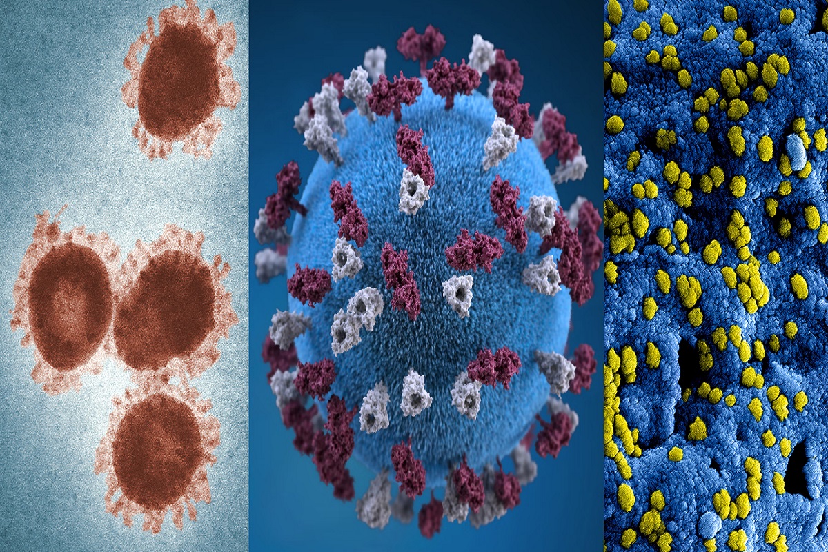 Details on How an Italian Man Contracted Monkeypox, HIV, and COVID at the Same Time During a Vacation Trip