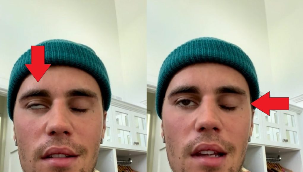 justin-bieber-face-paralyzed