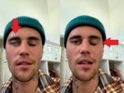 What Kind of Virus made Justin Bieber's Face Paralyzed?
