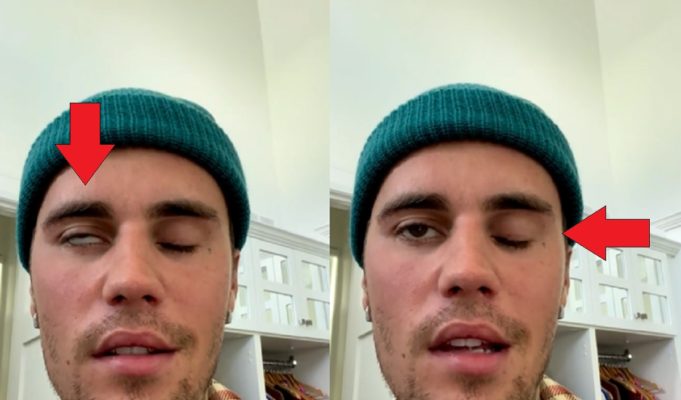 What Kind of Virus made Justin Bieber's Face Paralyzed?