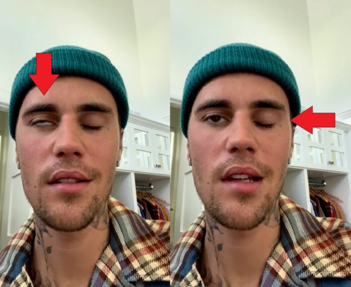 justin-bieber-face-paralyzed
