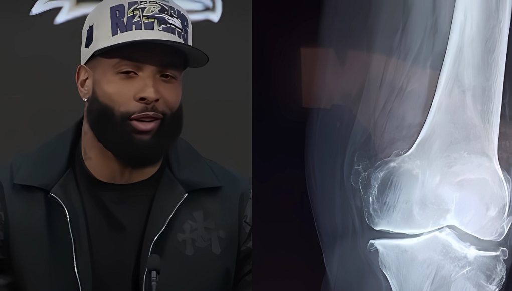 odell-beckham-jr-no-acl-science