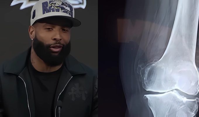 How Did Odell Beckham Jr. Play NFL Football with No ACL in His Knee? The Science Behind His Shocking Revelation