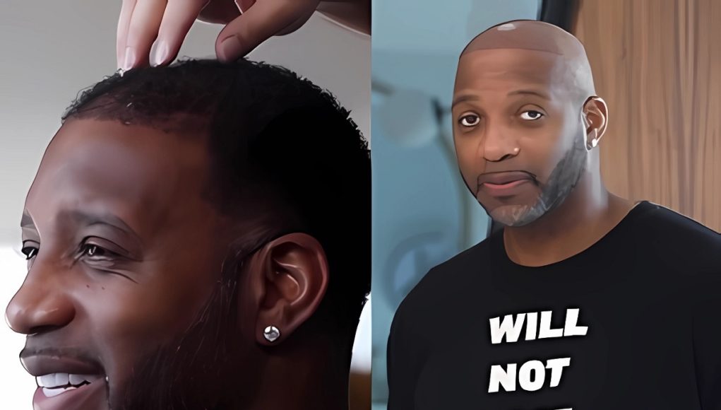 tracy-mcgrady-fake-hair-transplant