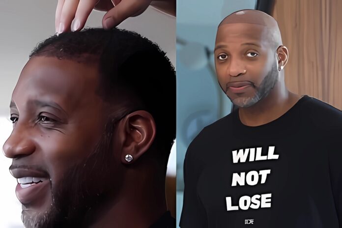 tracy-mcgrady-fake-hair-transplant