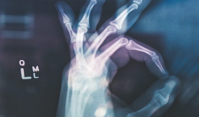 Did Doctors Botch Tyler Herro's Broken Hand Surgery? Details Behind Viral Conspiracy Theory
