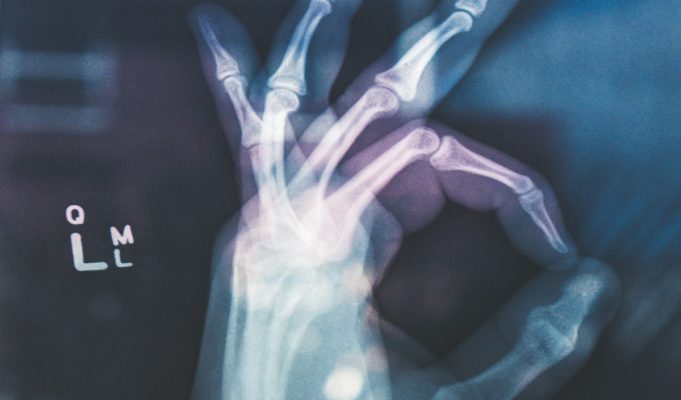 tyler-herro-hand-surgery-botched-conspiracy