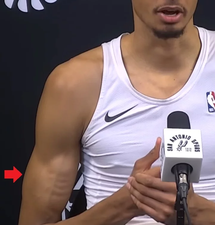 Victor Wembanyama's bicep dents