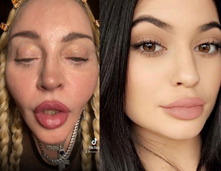 Madonna's Plastic Surgery Lips Side By Side with Kylie Jenner's Lips.