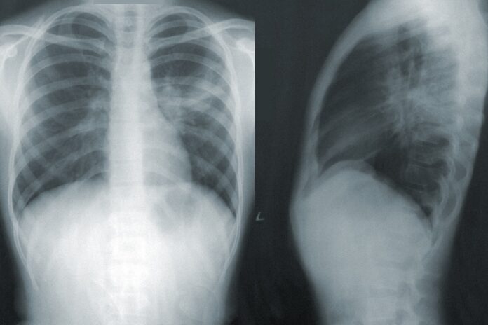 white-lung-syndrome-2