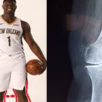 Anonymous Doctor Explains Why Zion Williamson Knee Soreness Issue Can't Be Fixed